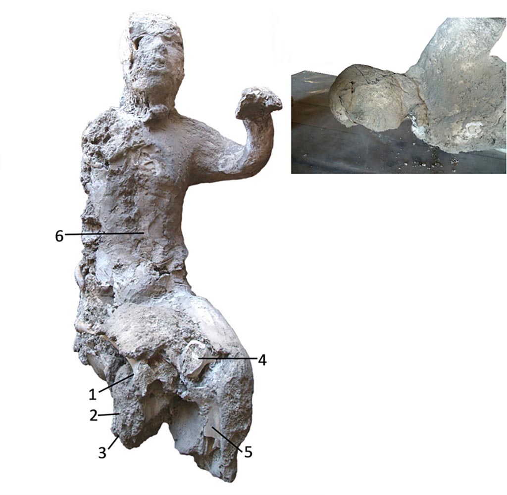 Victim 34 with pXRF measuring points (1–6) used in The Casts of Pompeii Project.
Cast #34 (Fig 8) from Terme Suburbane is a male adult individual (20–25 years old). The original position of the individual was right lateral decubitus. The right arm had the elbow flexed, separated from the body. The legs were parallel following the longitudinal axis of the body.
No obvious pathological conditions in victim 34 from Terme Suburbane, were observed.
Photo courtesy of The Casts of Pompeii Project. Use subject to CC BY 4.0 Deed
See Alapont L, Gallello G, Martinón-Torres M, Osanna M, Amoretti V, Chenery S, et al. (2023) The casts of Pompeii: Post-depositional methodological insights. PLoS ONE 18(8): e0289378, p. 9/19, fig. 8. https://doi.org/10.1371/journal.pone.0289378
Victim 34 may be a female, aged 13-19 years?
The victim was found in the Suburban Baths on the 28th of April 1960, roughly in the area between rooms 14-4-12-13.
There were traces of drapery on the waist and hips.
See Osanna, N., Capurso, A., e Masseroli, S. M., 2021. I Calchi di Pompei da Giuseppe Fiorelli ad oggi: Studi e Ricerche del PAP 46, p. 400-401, Calco n. 34.