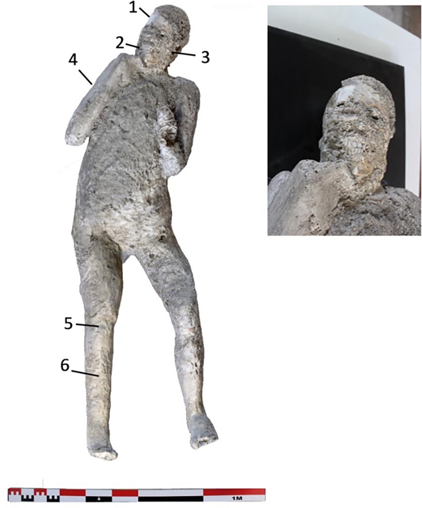 Victim 62. Cast #62 and pXRF measuring points (1–6).
The cast #62 is an adult individual (25–30 years old) identified as female, found interlaced to the left hand-forearm and holding a rope that would go over the left shoulder carrying a sack or bag. The original position of this individual was prone with the head resting on the face.
Photo courtesy of The Casts of Pompeii Project. Use subject to CC BY 4.0 Deed
See Alapont L, Gallello G, Martinón-Torres M, Osanna M, Amoretti V, Chenery S, et al. (2023) The casts of Pompeii: Post-depositional methodological insights. PLoS ONE 18(8): e0289378, fig. 3. https://doi.org/10.1371/journal.pone.0289378
Victim 62 is an adult male over 20 years of age.
The cast was found outside Porta Nola near the tomb of M. Obellius Firmus between the 2nd of August and the 21st of September 1976.
On the left forearm the drapery of the sleeve of the robe appears to be legible.
See Osanna, N., Capurso, A., e Masseroli, S. M., 2021. I Calchi di Pompei da Giuseppe Fiorelli ad oggi: Studi e Ricerche del PAP 46, p. 465-6, Calco n. 62.
